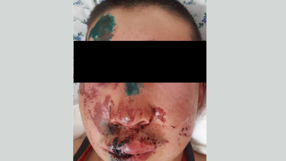 Нарында карындашына болушуп, ооруканага түшкөн бала. Аны арматура менен сабашкан