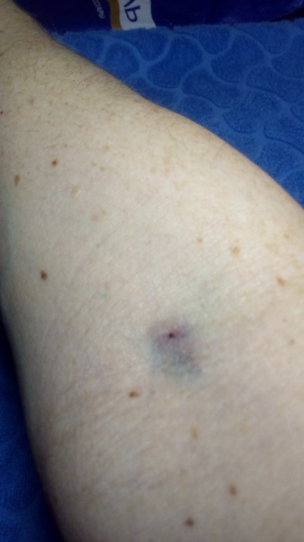 "Уйкусуратып, башты айлантат". Францияда 300дөн ашык адамга белгисиз ийне сайылган