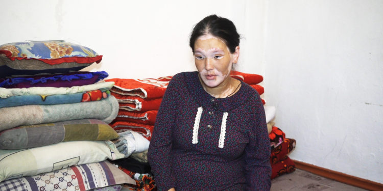 «Күйөөм мени «чаарала», «тиши жок кемпир» деп басынтчу». Ала оорусу менен жабыркаган келиндин тагдыры