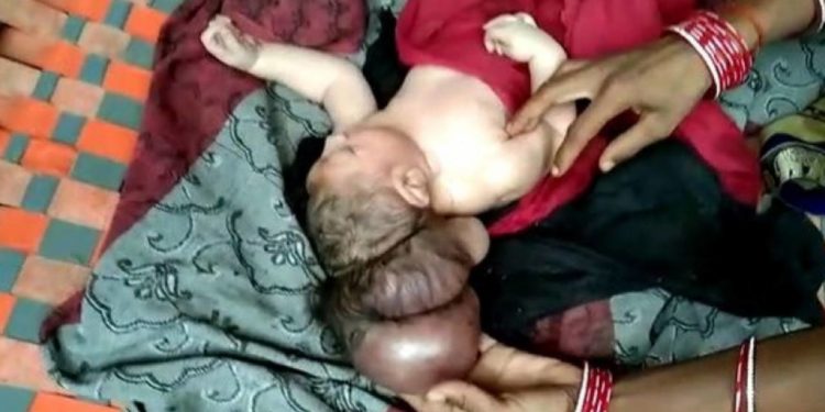 Индияда үч баштуу ымыркай төрөлдү (видео)