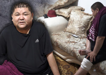 “Бир бутумдун сөөгү чирип жатат, дарылабаса кесиш керек болот” дейт Ташчайнар