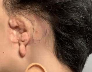 «Борбор Азияда биринчи жолу». Медициналык академияда протез кулак жасалды (сүрөт)