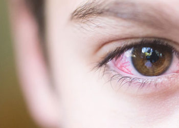 Көзүңүз кызарып, чылпактап жатабы? Омикрон штаммынын бир белгиси болушу мүмкүн