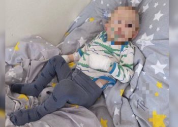 Сокулукта көгала болуп сабалган баланын абалы кандай? Башкы дарыгердин жообу