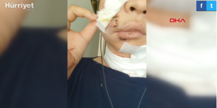 Кыргыз кызынын Стамбулдагы мейманканада бети жана моюну кескиленген абалда табылышы. Ишти консулдук көзөмөлгө алды