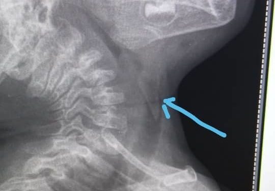 «Учурунда албасак, чарчап калмак». Оштогу ооруканага наристе шашылыш жеткирилген