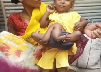 Индияда 4 кол, 4 буттуу «жөргөмүш кыз» жашайт