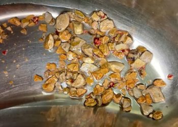 56 жаштагы кишинин бөйрөгүнөн 206 таш алышкан