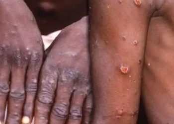 ДССУ маймыл чечегин пандемия деп жарыяладыбы? Министрликтин жообу