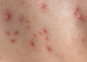 Орусияда маймыл чечеги оорусун жуктурган биринчи бейтап катталды