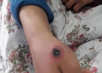 Таласта күйдүргүгө шектелип 4 адам ооруканага жаткырылды