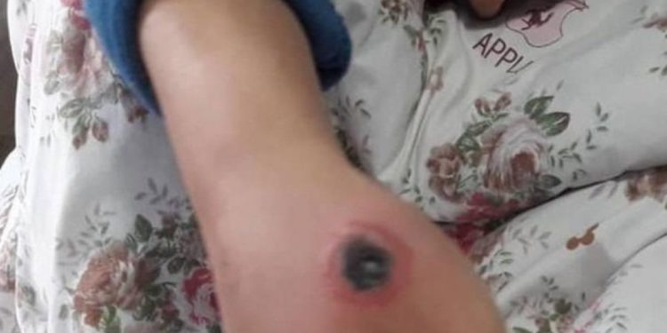 Таласта күйдүргүгө шектелип 4 адам ооруканага жаткырылды