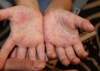 «Кусуу, баш ооруу, дене таптын көтөрүлүшү». Кыргызстанда энтеровирустук инфекциянын учурлары катталып жатат