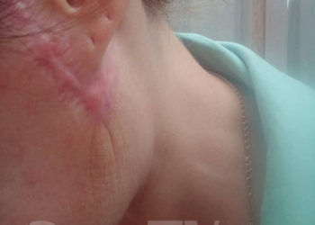 «Мурдагы бетимди кайрыгым келет». Бишкекте операциядан жабыркаган келин акыйкаттык издейт