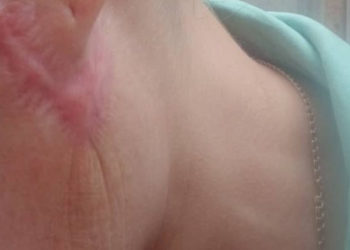 Бетине операция жасаткан соң ириңдеп, ооруп жатканын айткан келиндин иши боюнча комиссиялык экспертиза дайындалды