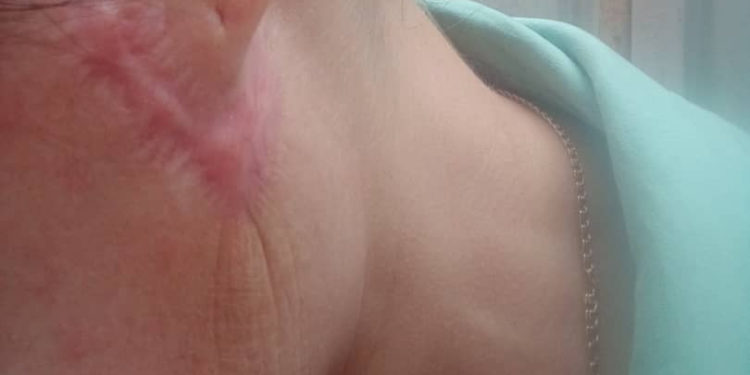 Бетине операция жасаткан соң ириңдеп, ооруп жатканын айткан келиндин иши боюнча комиссиялык экспертиза дайындалды