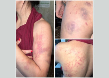 Ошто милиция тарабынан сабалганын айткан аялдын иши боюнча материал прокуратурага жөнөтүлдү