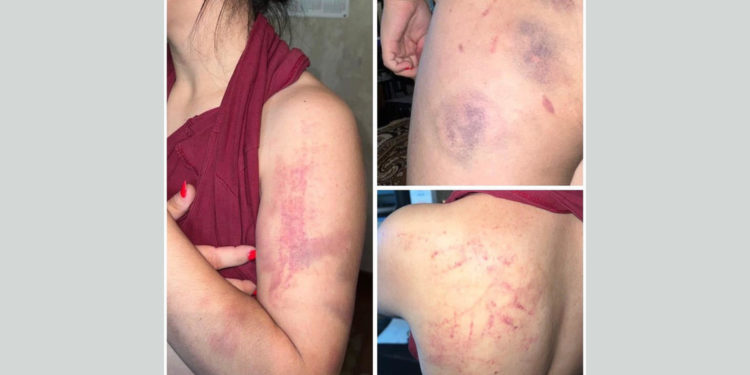 Ошто милиция тарабынан сабалганын айткан аялдын иши боюнча материал прокуратурага жөнөтүлдү