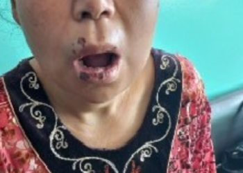 «Мойнумдан өйдө соо жерим жок». Оштогу психиатрия борборунда аял киши сабалганы маалымдалды