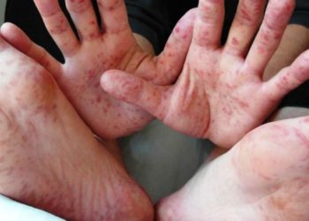 Өлкөдө жыл башынан бери 6 адамдан кызамык жана кызылча оорусу катталды