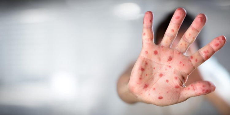 Министрлик: «Өлкөдө кызамык боюнча абал туруктуу»