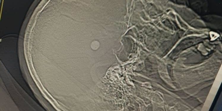 Жалал-Абаддагы нейрохирургдар башына ок тийген жаранды сактап калышты