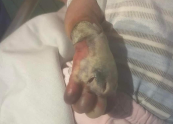 Токтогулда ымыркай дарыгерлердин шалаакылыгынан колунан ажыраганы айтылууда