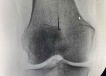 Казакстанда аял 45 жыл тизесиндеги ийне менен жүргөн