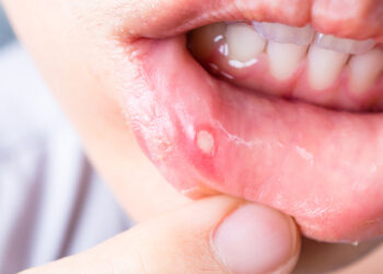 Дарыгер: «Стоматит өлүмгө алып келген оорунун белгиси болушу мүмкүн»