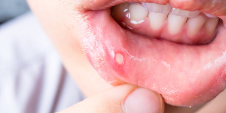 Дарыгер: «Стоматит өлүмгө алып келген оорунун белгиси болушу мүмкүн»