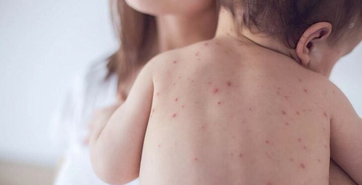 Кызамык, кызылча жана паротитке каршы эмдөөнү кайдан алууга болот?