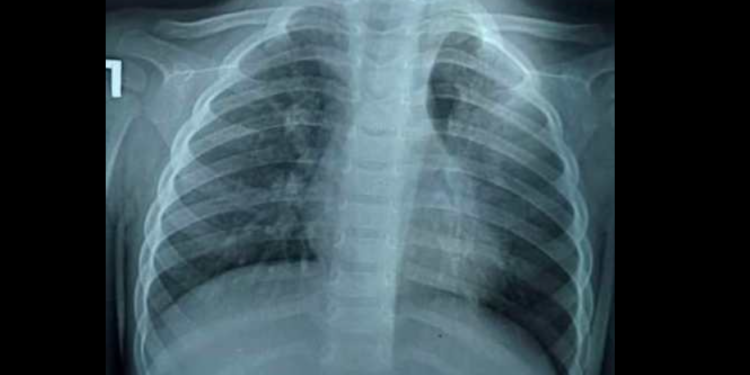 Бишкекте 1 жаштагы баланын өпкөсүнөн жүгөрүнүн даны алынды