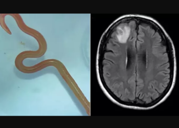 Австралияда аялдын мээсинен жыландарда кездешчү тирүү курт алынды