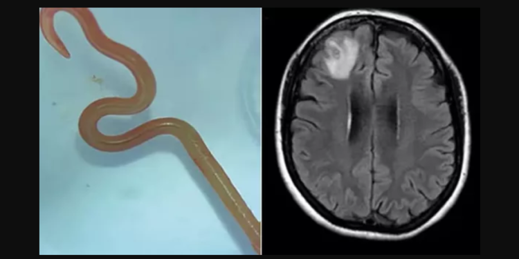 Австралияда аялдын мээсинен жыландарда кездешчү тирүү курт алынды