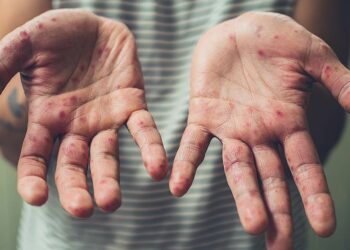 Ата-энесинин диний көз карашынан улам эмдөө албаган 2 бала кызылчадан каза болду