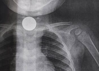 «Жөтөлүп жүрө берген». Ошто 2 жашар наристеге операция жасалды