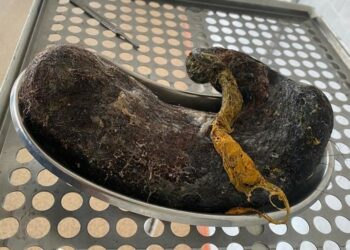 Бишкекте 18 жаштагы кыздын ашказанынан 4 килограммга жакын чач алынды (сүрөт)