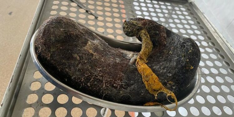 Бишкекте 18 жаштагы кыздын ашказанынан 4 килограммга жакын чач алынды (сүрөт)