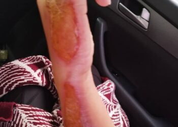 Акыйкатчы институту: «Бишкекте аялды чогуу жашаган эркек катуу сабап, колуна үтүк басып, андан соң зордуктаган»