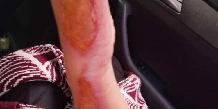 Акыйкатчы институту: «Бишкекте аялды чогуу жашаган эркек катуу сабап, колуна үтүк басып, андан соң зордуктаган»