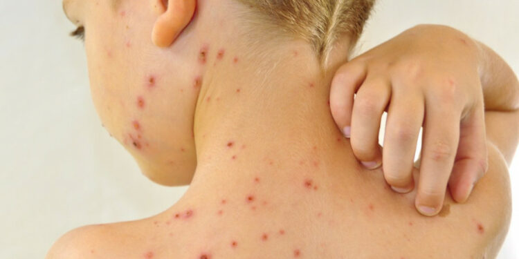 Жалал-Абадда кызамык оорусуна байланыштуу эки мектеп карантинге жабылды