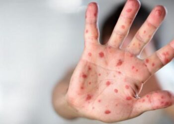 Өлкөдө кызамык боюнча кырдаал курч бойдон калууда