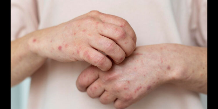 Министрлик өлкөдө кызамык боюнча кырдаал курч бойдон экенин билдирди