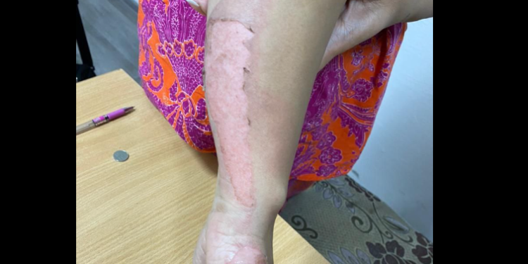 «Тараптар элдешкен». Бишкекте аялдын колуна үтүк басып, зордуктоого шектүү сот залынан бошотулду