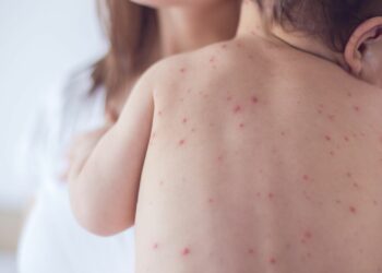 Министр: «9 бала кызамыктан каза болду»