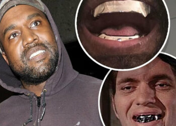 Канье Уэст тиштерин жулдуруп, 850 миң долларга протез койдурган