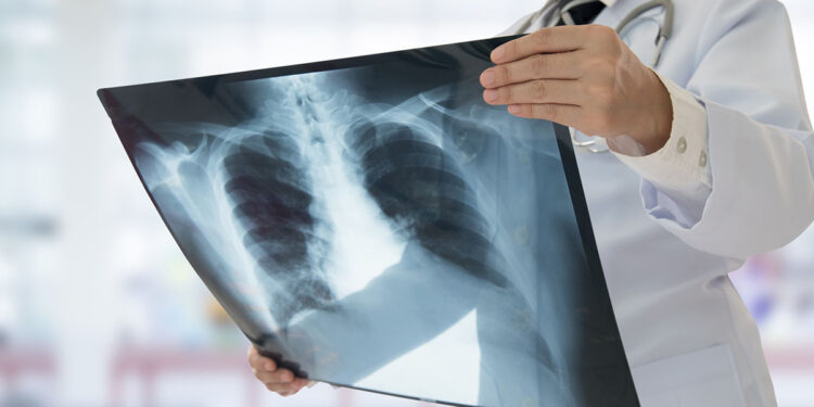 Бишкектеги №67 мектептин окуучусунан кургак учук аныкталды