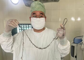 Бир тутам чач… Бишкекте 8 жашар кызга уникалдуу операция жасалды