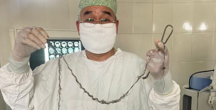 Бир тутам чач… Бишкекте 8 жашар кызга уникалдуу операция жасалды