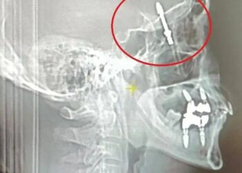 Түркияда тиш доктур имплантты бейтаптын мээсине чейин бурап салган